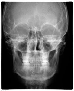 Radiografía antero posterior