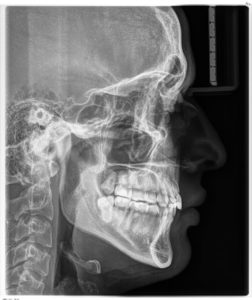 Radiografía Lateral de Cráneo