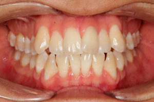 Intraoral frontal