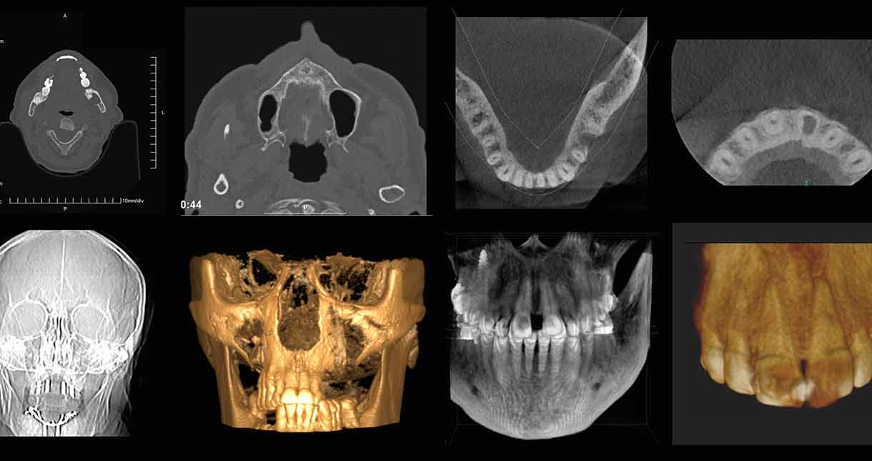 tomografía cone beam dicorsa