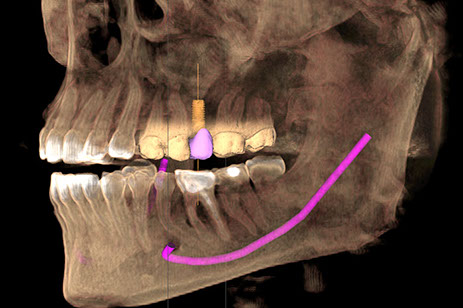 Tomografía de nervio dentario