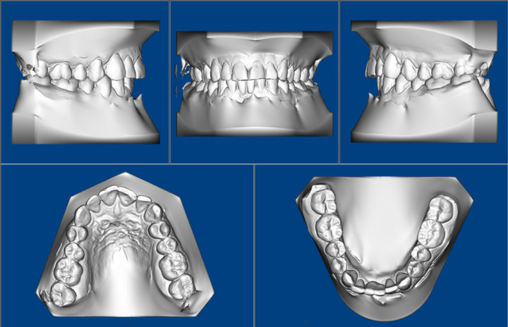Modelos dentales digitales
