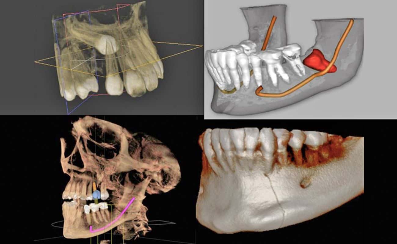 tomograf-a-computarizada-cone-beam-en-endodoncia-dicorsa