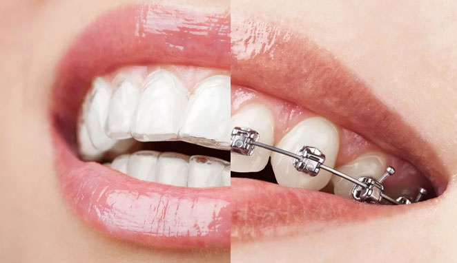Alineadores vs. Brackets – Una Comparación Detallada para Dentistas