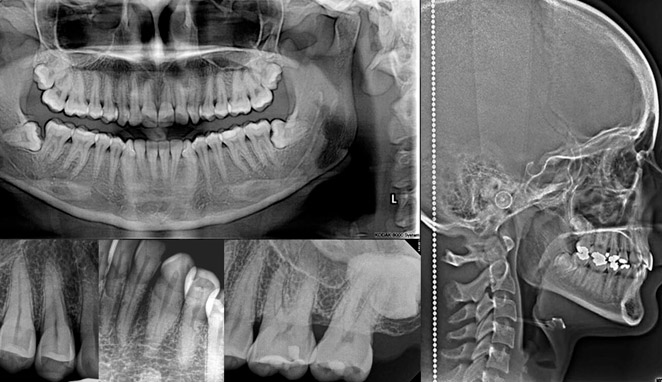 Radiografía Intraoral Vs Radiografia extraoral